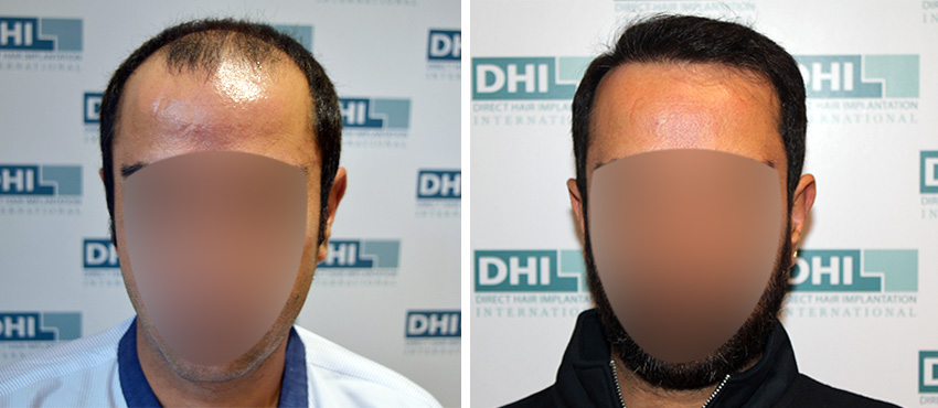 DHI before & after hair transplant results